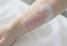 Co je vitiligo příčiny a léčba - ilustrační foto