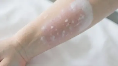 Co je vitiligo příčiny a léčba - ilustrační foto