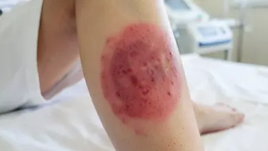 jak vypadá růže na noze a jak ji léčit - Jak vypadá růže na noze a - ilustrační foto