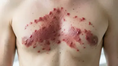 Pásový opar příznaky léčba a prevence - ilustrační foto