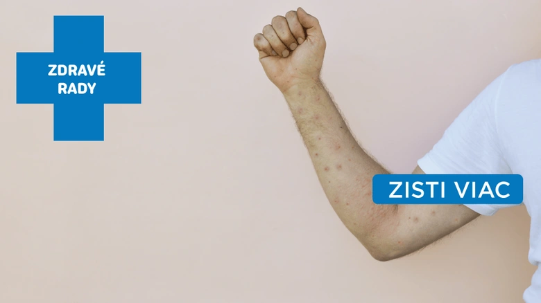 Ruka dítěte s vyrážkou, která může být příznakem osýpek.
