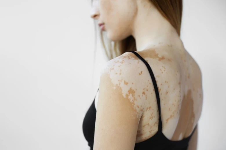 Woman with vitiligo skin condition