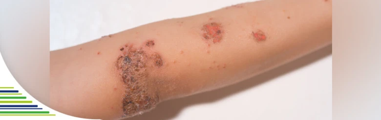 Fotografie ruky s příznaky impetigu včetně krust.