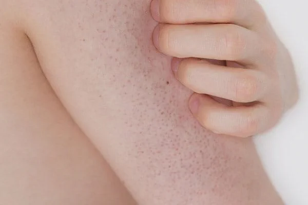 Ruce dotýkají se kůže s kuřecí kůží na paži.