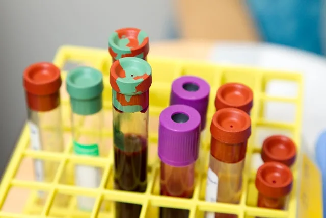 Krevní vzorky ve žlutém držáku pro laboratorní testování.