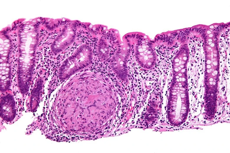 Crohn's disease histology