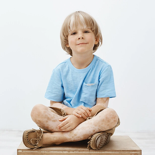 Child with vitiligo