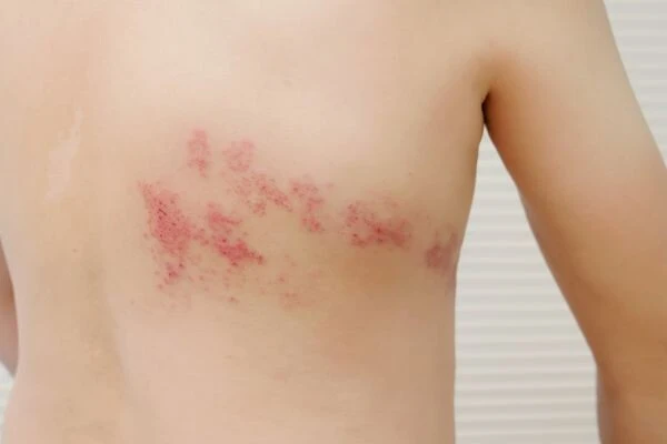 Shingles rash on torso