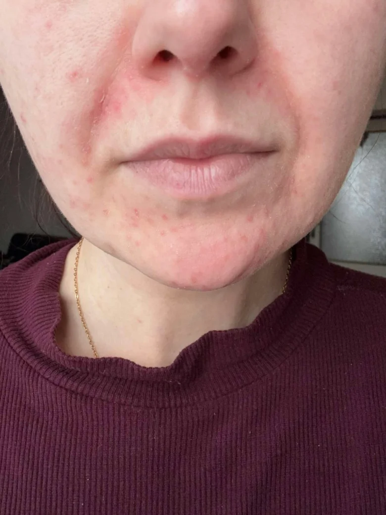 Přiblížená tvář s příznaky perorální dermatitidy kolem rtů.