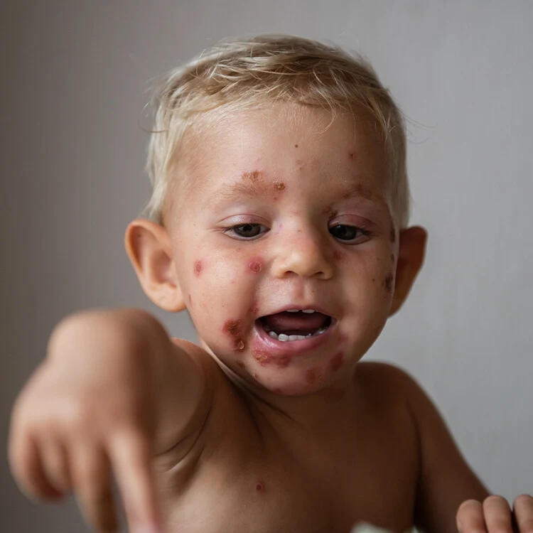 Malý dítě s červenými puchýři na obličeji způsobenými impetigem.