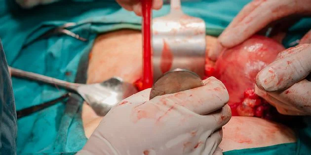 Vaginální hysterektomie s chirurgickými nástroji v operaci