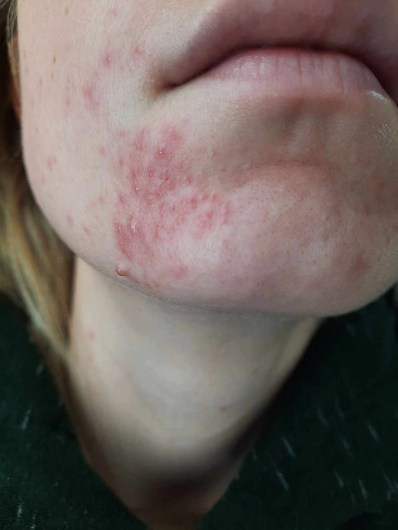 Příznaky periorální dermatitidy na kůži pod ústy.