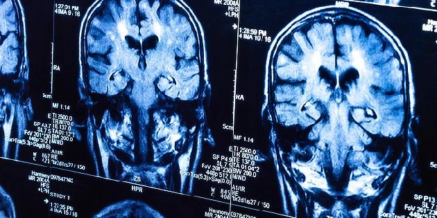 Brain mri scan with tumor