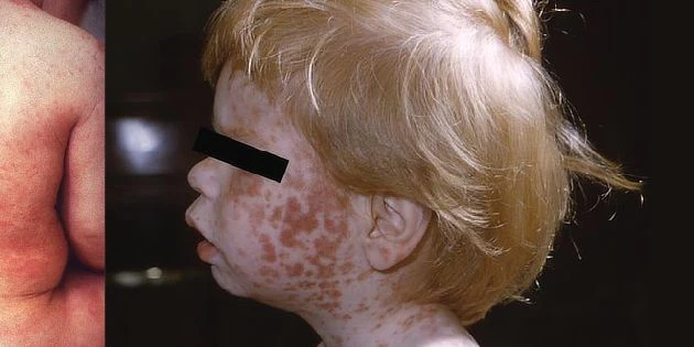 Child with fifth disease rash