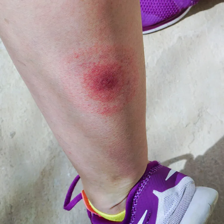 Červená vyrážka na noze typická pro lymskou boreliózu.