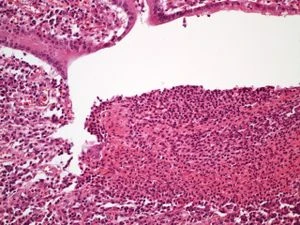 Histologický příznak zánětlivého střeva při Crohnově chorobě.
