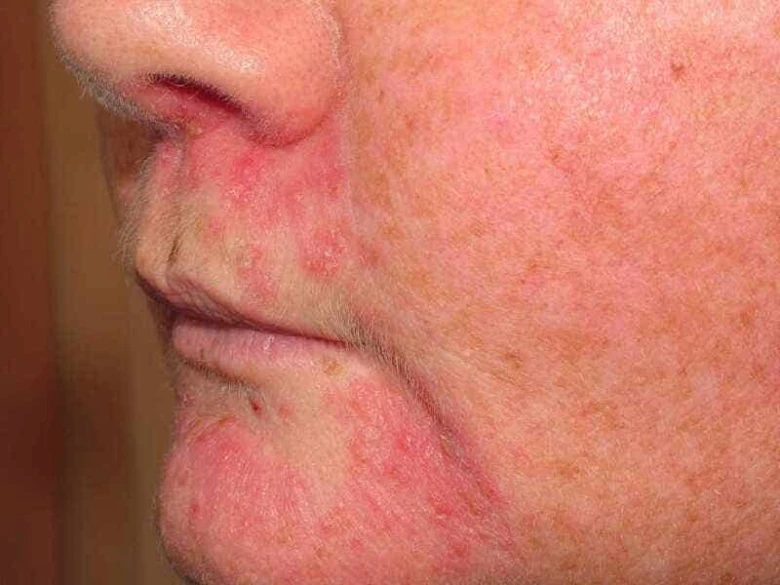 Zvětšený pohled na obličej s příznaky periorální dermatitidy.