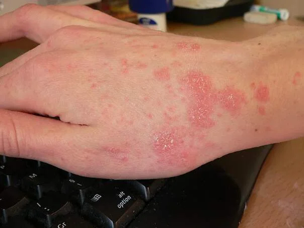 Scabies rash on hand