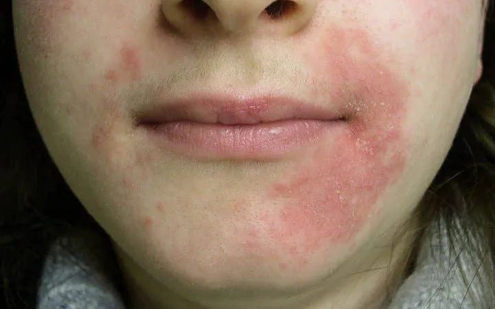 Příznak perorální dermatitidy na obličeji kolem úst.