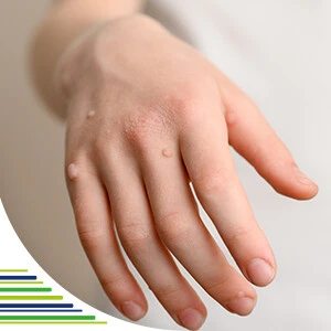 Hand with molluscum contagiosum lesions