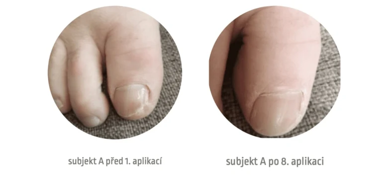 Porovnání nehtu před léčbou plísně po osmi aplikacích.
