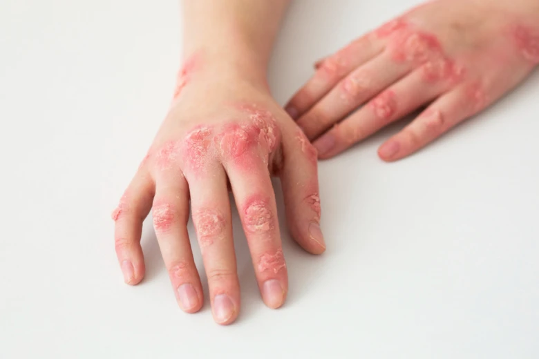 Ruce s červenými šupinatými skvrnami typickými pro psoriázu.