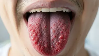 Co je malinový jazyk a jaké má příznaky - ilustrační foto