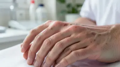 co je systémový lupus erythematodes a jak se projevuje - Co je systémový lupus erythematodes a - ilustrační foto