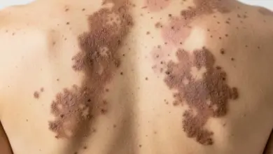 Jak léčit pityriasis versicolor a jaké jsou příčiny - ilustrační foto