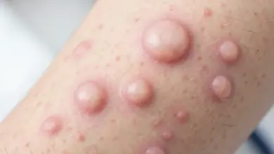 neurofibromatóza příznaky a léčba - Neurofibromatóza - ilustrační foto
