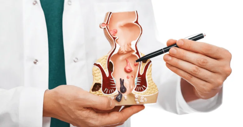 Lékař ukazuje na model s abscesem v okolí konečníku.
