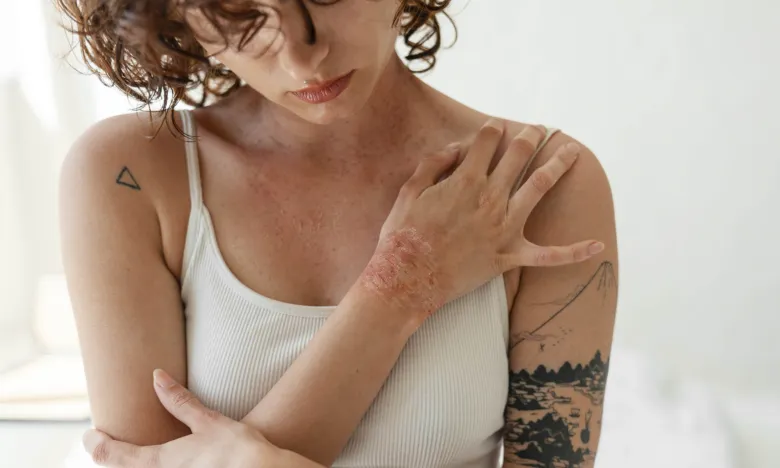Žena s červenými vyrážkami na předloktí ukazuje příznaky kontaktního zánětu kůže.
