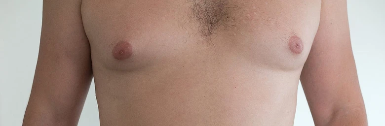 Mužský hrudník s gynekomastií, příznaky zvětšených bradavek.