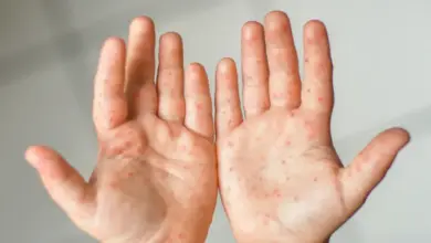 Ruce s vyrážkou typickou pro syndrom ruka noha ústa.