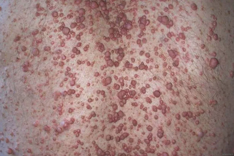 Kožní neurofibromy na povrchu lidské kůže.