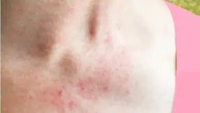 Červené skvrny na kůži v oblasti krku a hrudníku.