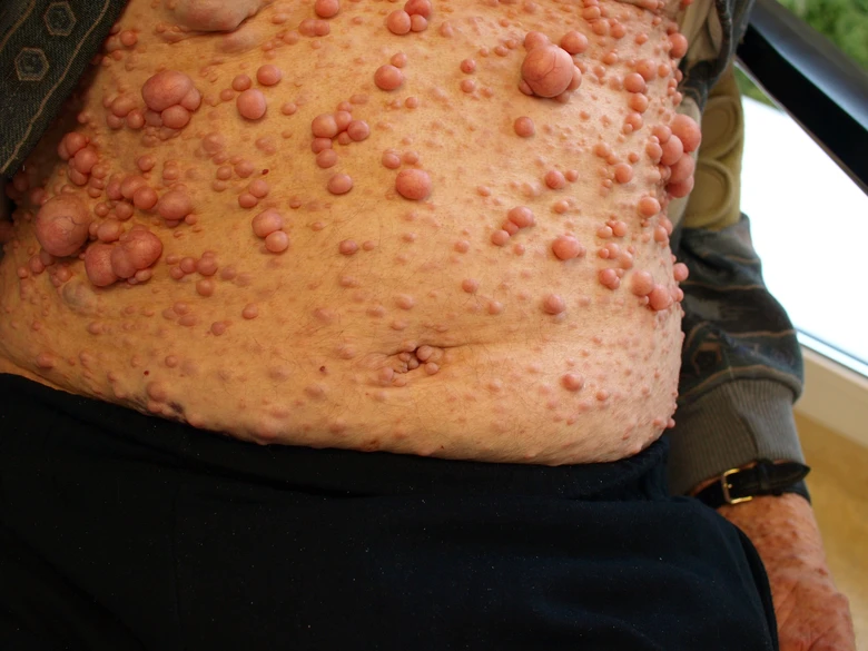 Kůže s mnoha kožními neurofibromy u pacienta s neurofibromatózou.