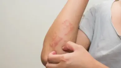 Červená vyrážka na lokti způsobená kontaktní dermatitidou.
