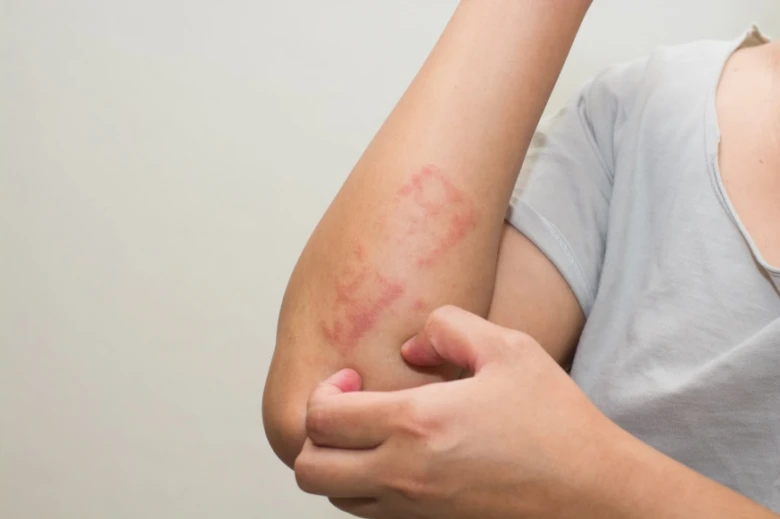 Červená vyrážka na lokti způsobená kontaktní dermatitidou.