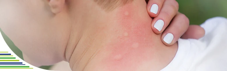 Child's flea bite rash