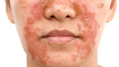 Příznaky seboroické dermatitidy na obličeji s červeností a olupováním.