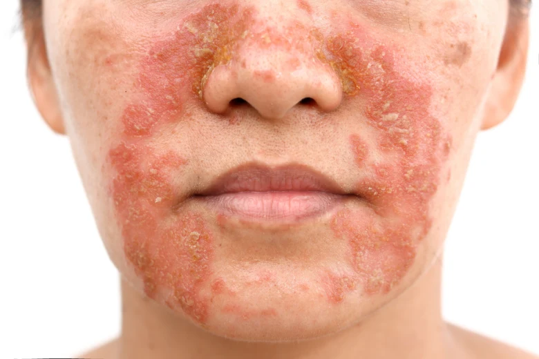 Příznaky seboroické dermatitidy na obličeji s červeností a olupováním.