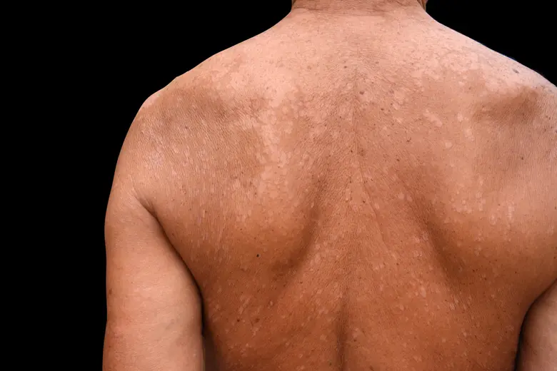 Zadní strana těla s plaky světlejší kůže při pityriáze versicolor.