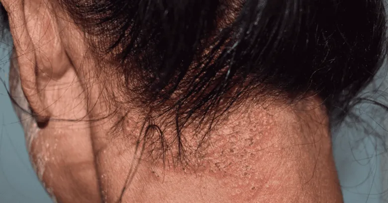 Příznaky seboroické dermatitidy na krku u vlasové linie.