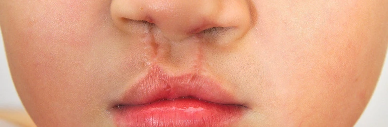 Fotografie rozštěpu rtu u dítěte s patrem.