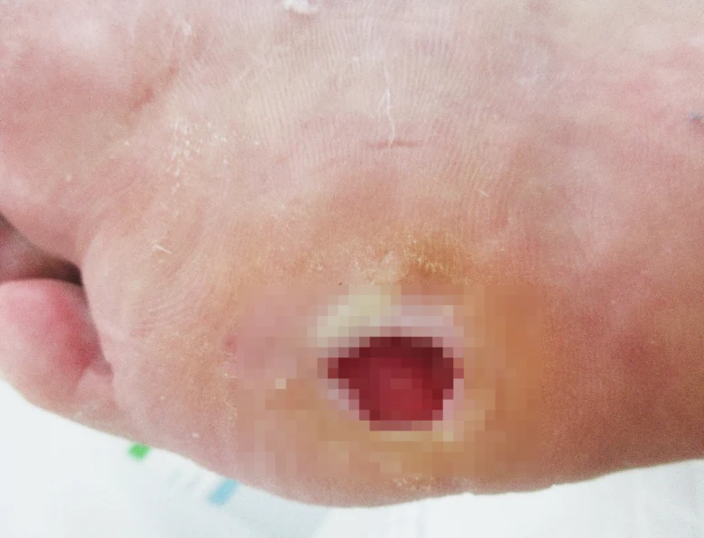 Otevřená rána na chodidle u diabetické nohy.