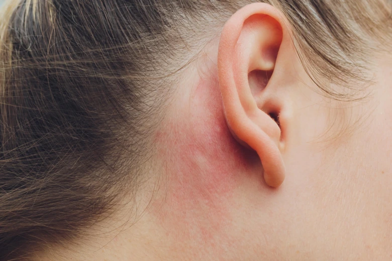 Červená vyrážka za uchem způsobená kontaktní dermatitidou.