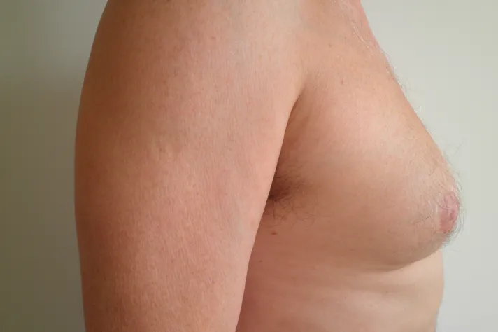 Stranový pohled na prsa muže s gynekomastií.