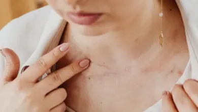 Žena ukazuje prstem na keloidní jizvu na krku.
