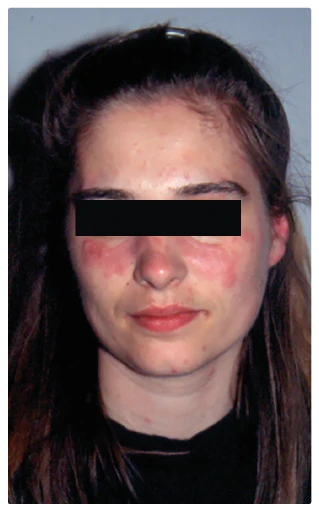 Female face with rash